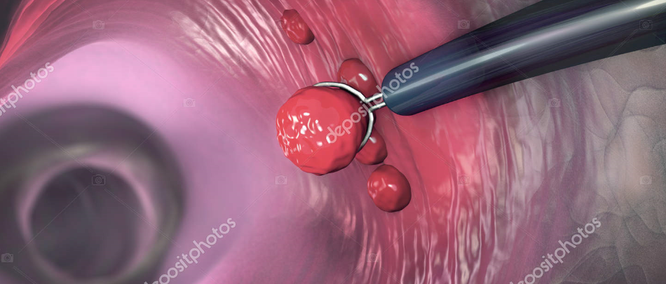 removal-of-a-colonic-polyp