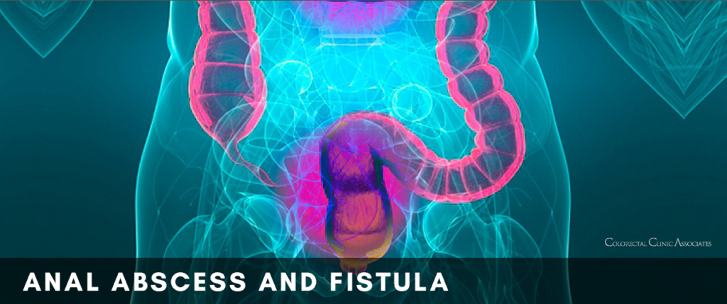 Anal Abscess And Fistula