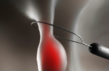 Polyps-of-The-Colon-and-Rectum_03