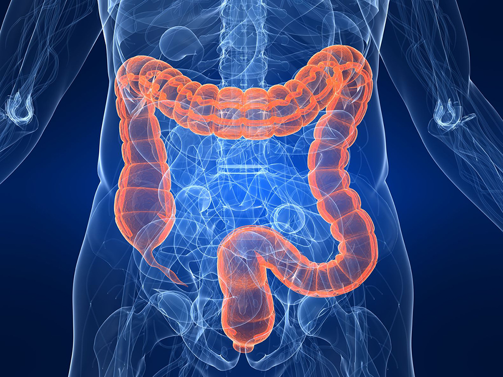 Colorectal Cancer