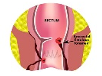 Anal Abscess and Fistula