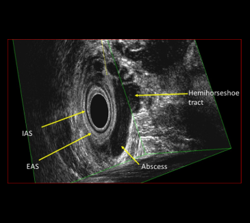 Endoanal Ultrasound 002