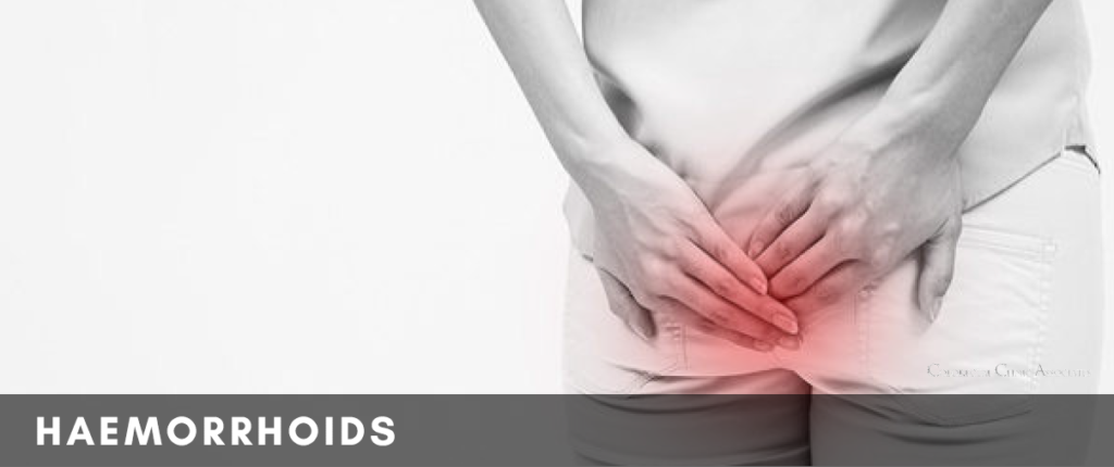 Haemorrhoids