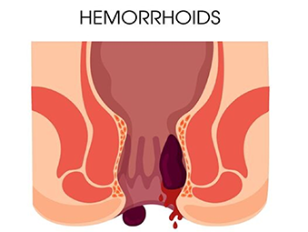Haemorrhoids