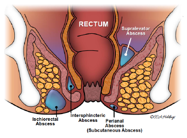 Anal Abscess