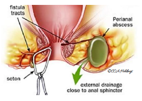 Anal Abscess