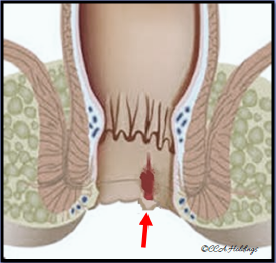 Anal Fissure