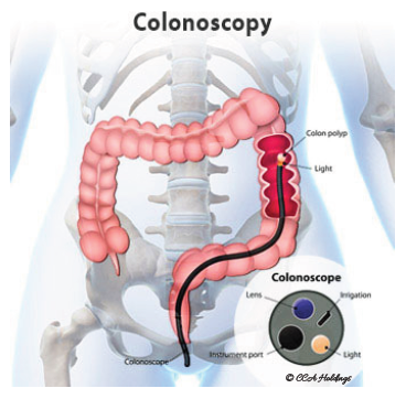 Colonoscopy