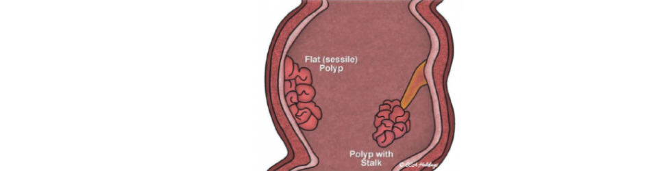 colon-polyps