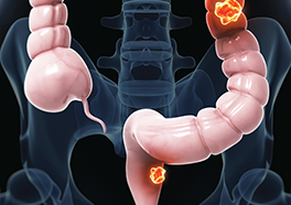 Treatment Options for Different Stages of Cancer