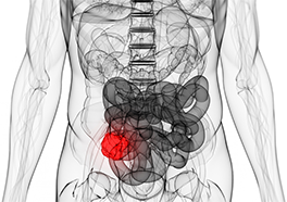 Colorectal Cancer Screening. Why you need to do it now!